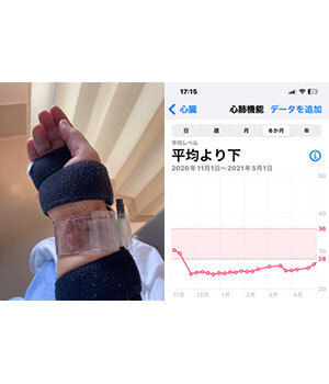 AppleWatchとiPhoneに救われた私の心臓